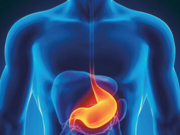 Hablando Sobre Acidez y Reflujo